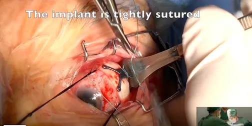 Titanium Macular Buckle Placement