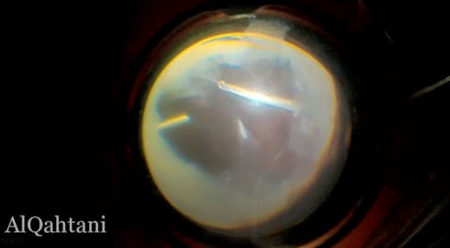 Bleb-Related Endophthalmitis