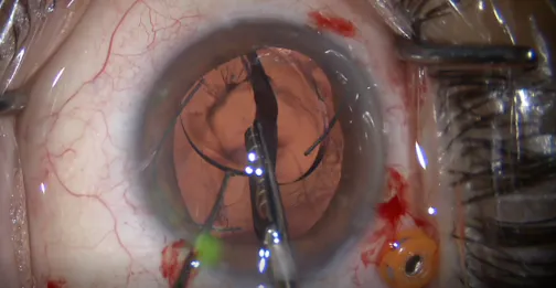 Light Adjustable Lens Removal