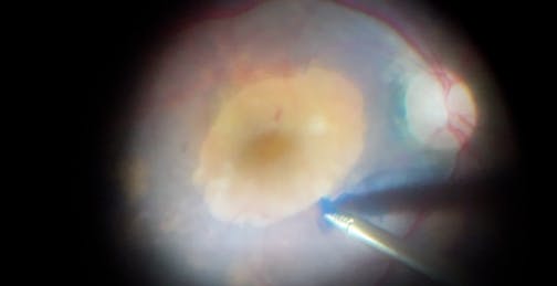 Vitrectomy With ILM Peel After Ocular Trauma With IOFB