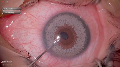 Iris Implant Removal