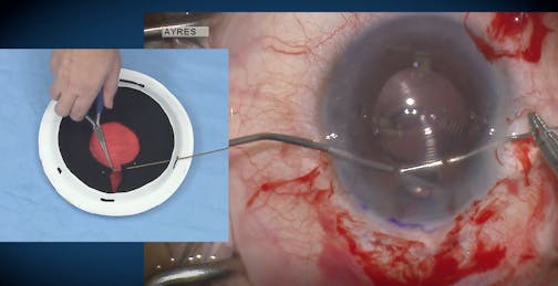 Modified Sliding Knot Technique With Paper Plate Model and Surgical Video