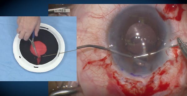 Modified Sliding Knot Technique With Paper Plate Model and Surgical Video thumbnail