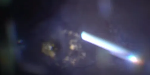 Real-Time Intravitreal Injection of Ozurdex