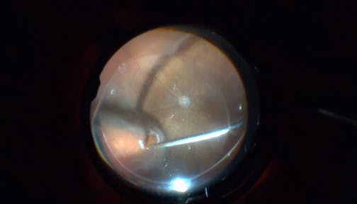 Remaining Subretinal Fluid Following Fluid Air Exchange