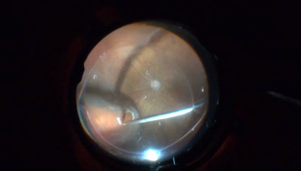 Remaining Subretinal Fluid Following Fluid Air Exchange thumbnail