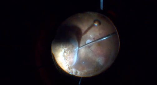 Retinal Redetachment-Related Hole