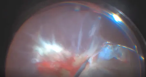 Diabetic Tractional Retinal Detachment