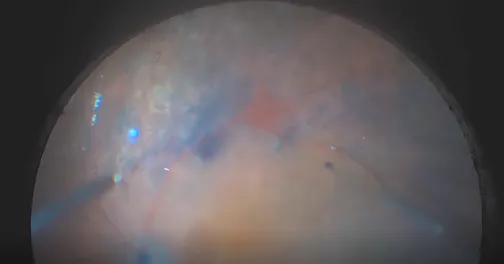 Retinal Detachment in Diabetic Proliferative Vitreoretinopathy