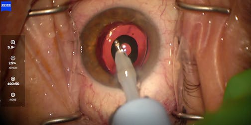 IC-8 Apthera Implantation