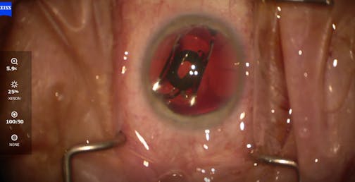Irregular Astigmatism, No Problem