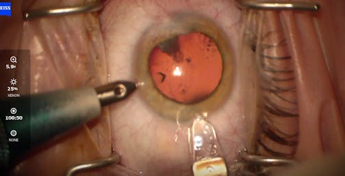 Traumatic Cataract and Aberrated Cornea