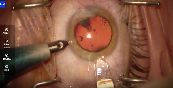 IC-8 Apthera IOL in Traumatic Cataract thumbnail