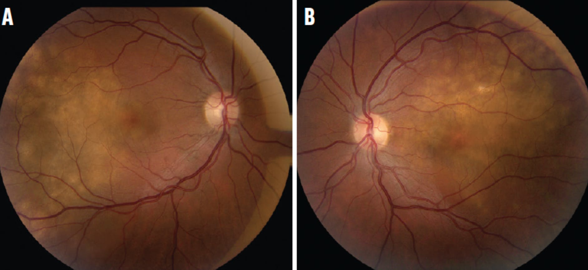 Choroidal Metastasis Associated With Oropharyngeal Carcinoma - Retina Today