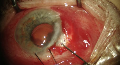 Xen Gel Stent in Traumatic Glaucoma: Implantation and Re-Implantation