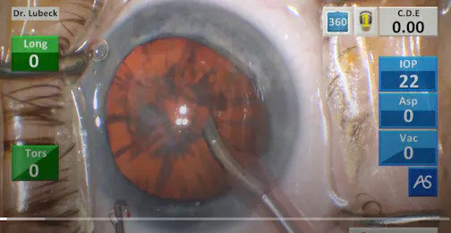 Dr. Lubeck's ActiveSentry Case Video