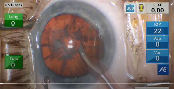 Dr. Lubeck's ActiveSentry Case Video thumbnail