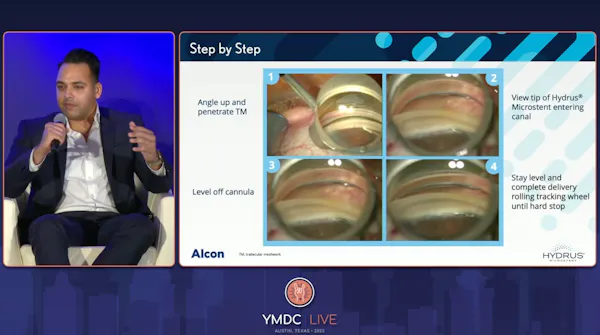 The Finer Points of MIGS thumbnail