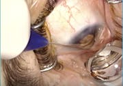 Glaucoma: A Deep Dive on the Comprehensive Mechanism of Canaloplasty