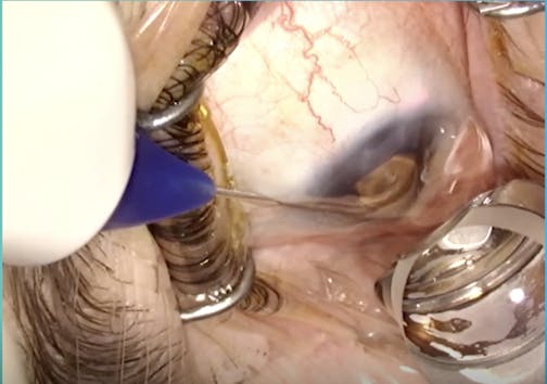 Glaucoma: A Deep Dive on the Comprehensive Mechanism of Canaloplasty