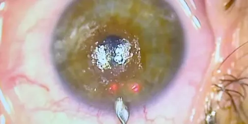 Removal of Epithelial Ingrowth After SMILE