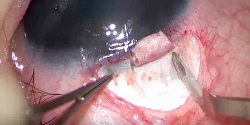 Visco Circumferential Suture Trabeculotomy in Primary Congenital Glaucoma