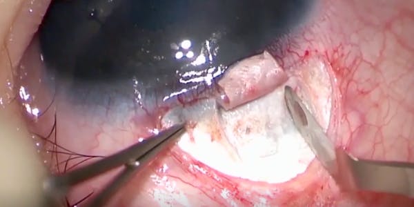 Visco Circumferential Suture Trabeculotomy in Primary Congenital Glaucoma thumbnail