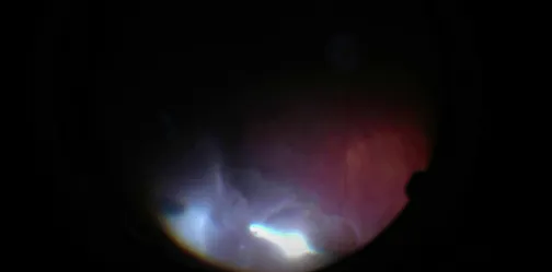 Passive Shaving Technique in Retinal Detachment Repair