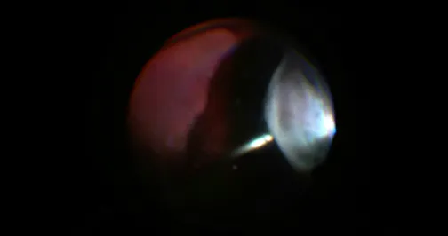 Passive Shaving Allows for Improved Stability During Vitrectomy