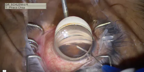 Hemi-GATT With the iTrack Advance Canaloplasty System