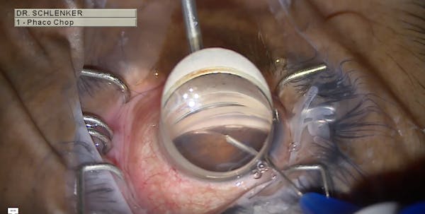 Hemi-GATT With the iTrack Advance Canaloplasty System thumbnail