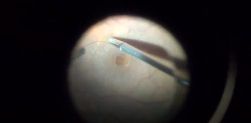 Three Layers on a Full-Thickness Macular Hole