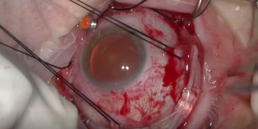 Pneumobuckle for a Phakic Retinal Detachment