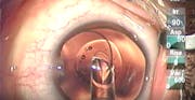 Posterior Optic Capture