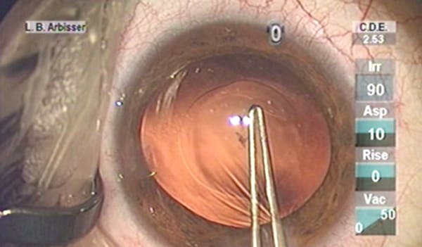 Posterior Optic Capture Demonstration thumbnail