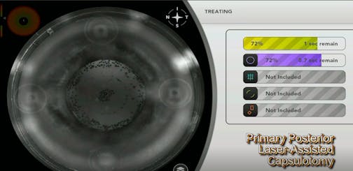 Femtosecond Posterior Capsulotomy (Off-label)