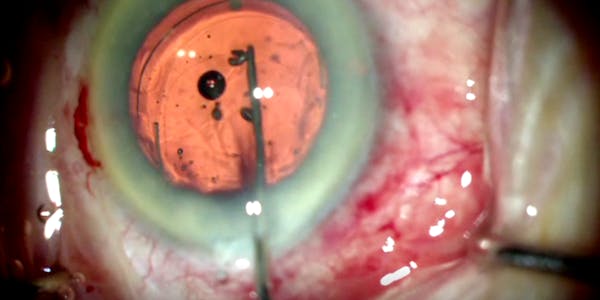 Scleral Bi-Capsulotomy Capture thumbnail