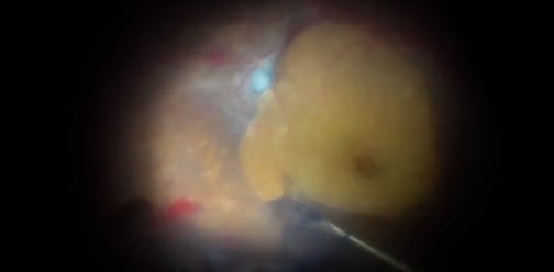 Triple Peel for Severe Diabetic Retinopathy With Adherent Hyaloid and Tractional Retinal Detachment