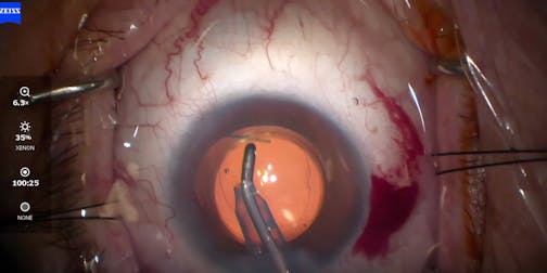 Addressing IOP and QOL With LAL, iStent, and Dextenza