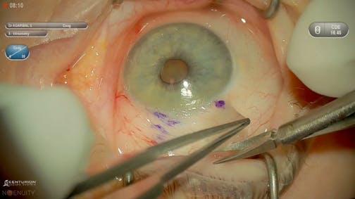 Pterygium Excision With Conjunctival Autograft