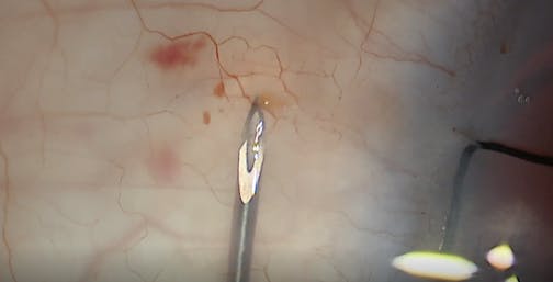 Xen Primary Needling