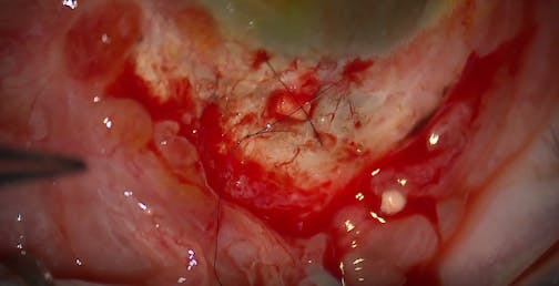 Scleral Plug for a Leaking Sclerostomy