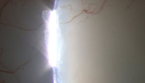 YAG Laser to Revive a Failed Xen