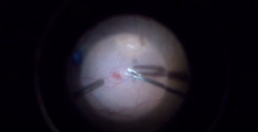 Challenging Full-Thickness Macular Hole