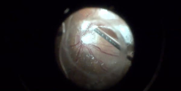 Severe Vitreoretinal Traction With Semi-Circular Retinal Detachment thumbnail