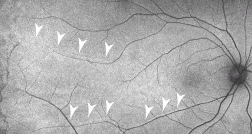 Retinal Displacement on FAF Imaging: The Tip of the Iceberg