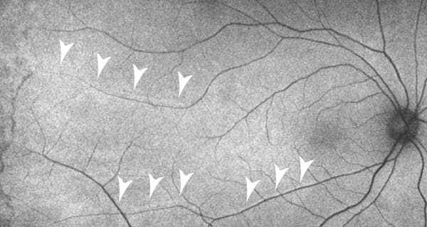 Retinal Displacement on FAF Imaging: The Tip of the Iceberg thumbnail