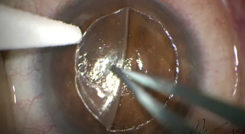 LASIK Ingrowth Removal