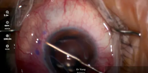 Xen Gel Stent Minimally Open Technique