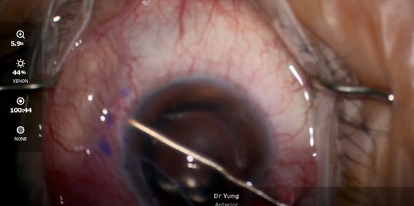 Xen Gel Stent Minimally Open Technique thumbnail